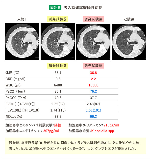 吸入誘発試験（加湿器肺）陽性例 B）誘発後、炎症所見増加、発熱と共に画像ではすりガラス陰影が増加し、その後速やかに改善した。なお、加湿器水中のエンドトキシン、β―Dグルカン、クレブシエラが検出された。