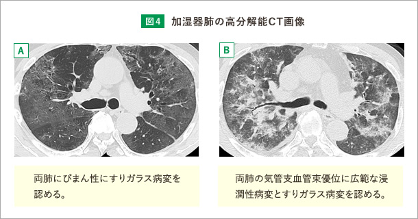 加湿器肺のHRCT画像