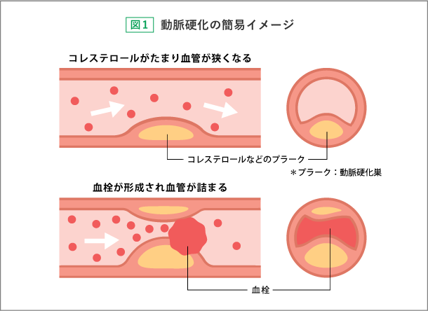 動脈硬化の簡易イメージ