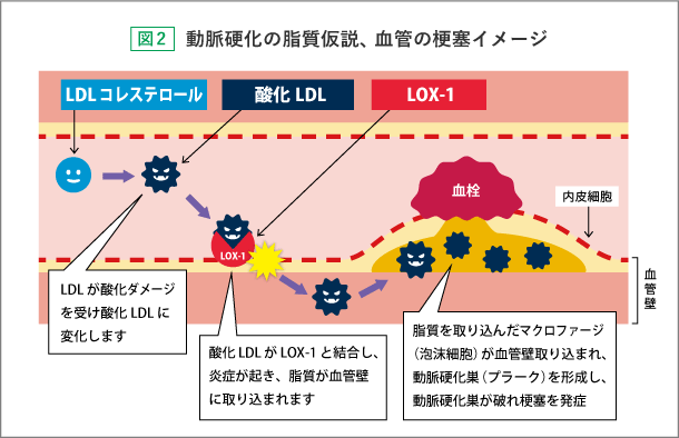 動脈硬化の脂質仮説、血管の梗塞イメージ