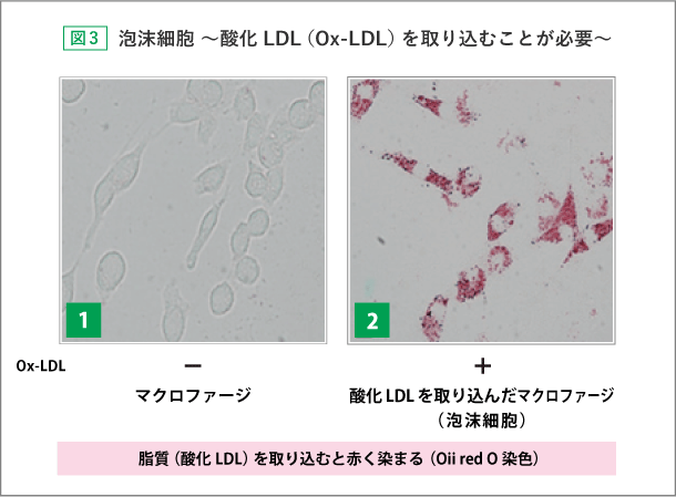 泡沫細胞～酸化LDL（Ox-LDL）を取り込むことが必要～