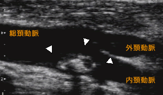 総頚動脈